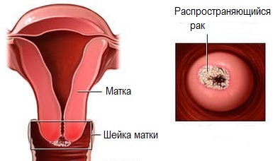 Лечение рака шейки матки в Израиле