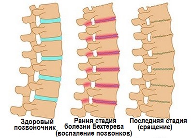 Лечение болезни Бехтерева в Израиле