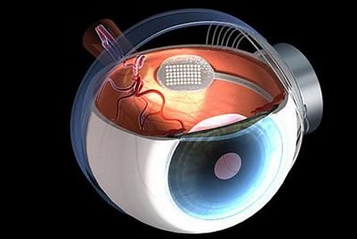 В Ираиле проведена уникальная операция по имплантации микрочипа в глаз слепого пациента.