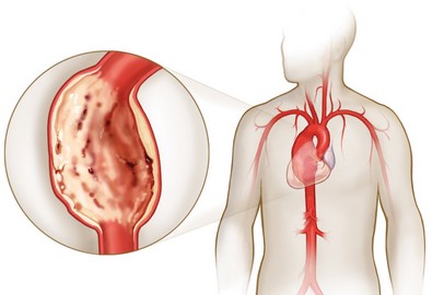 Лечение аневризмы аорты в Израиле