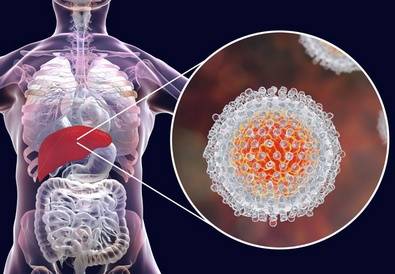 Лечение гепатита С в Израиле
